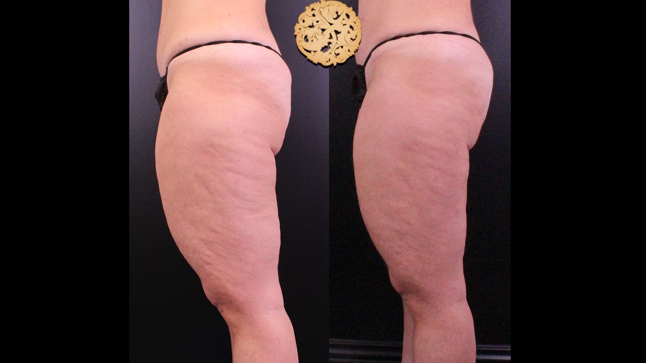 Cellfina Before & After