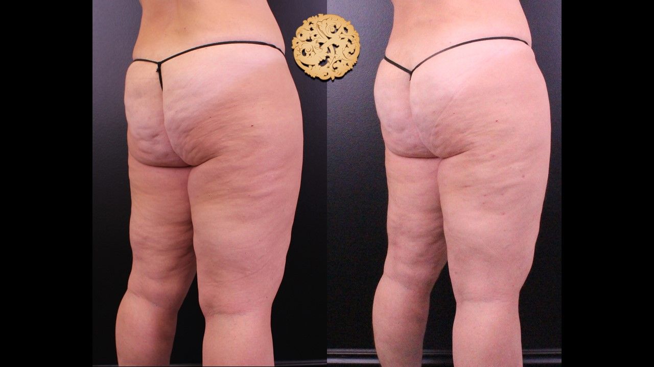 Cellfina Before & After