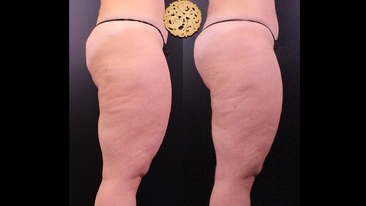 Cellfina Before & After