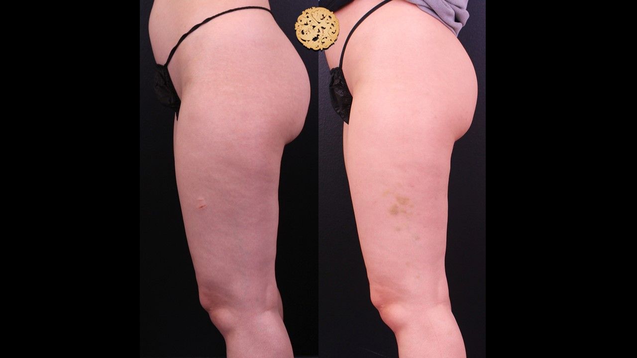 Cellfina Before & After