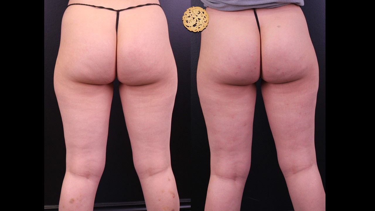 Cellfina Before & After