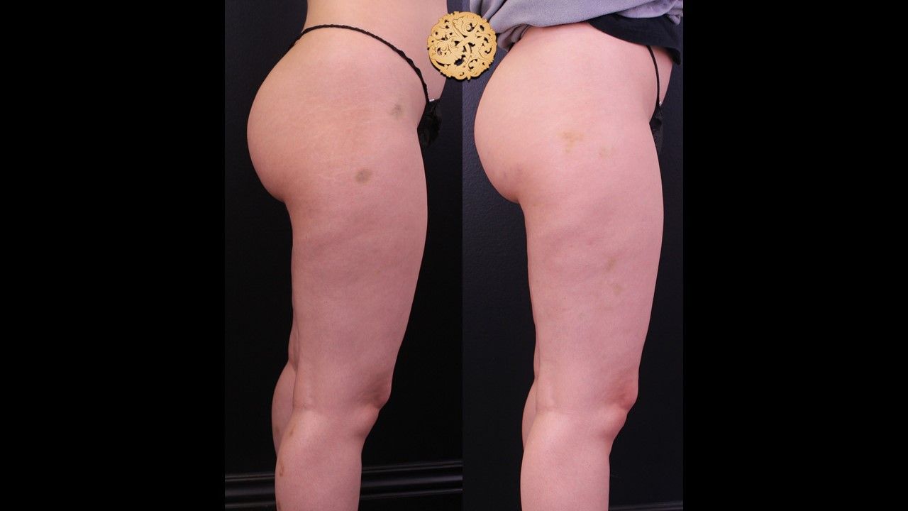 Cellfina Before & After