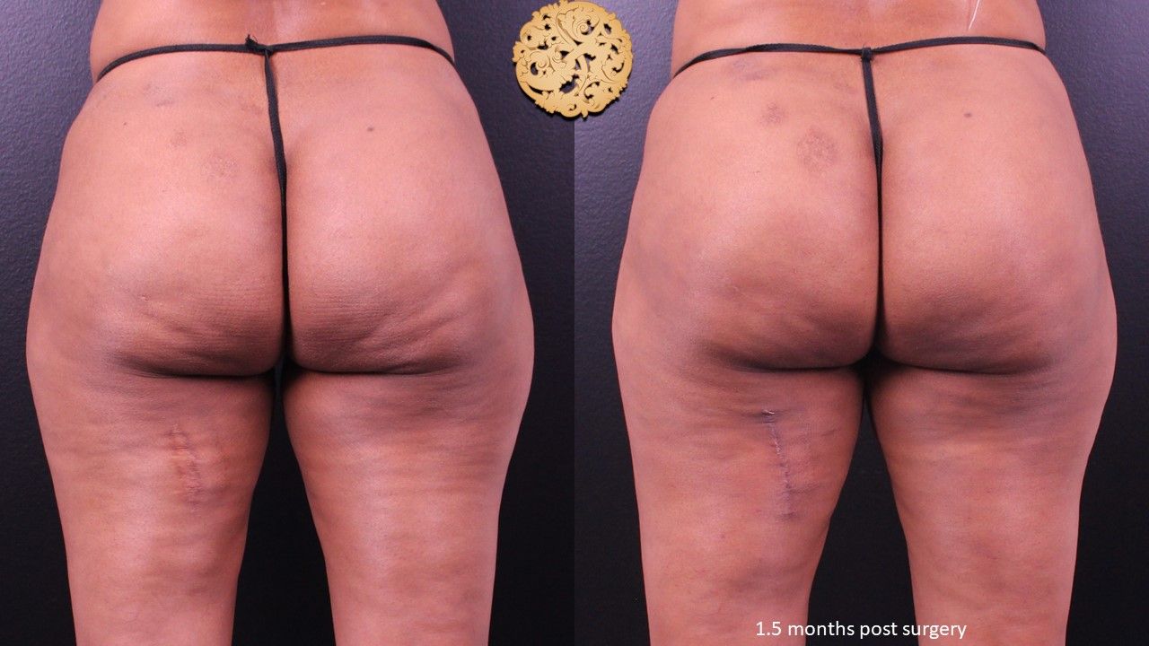 Cellfina Before & After