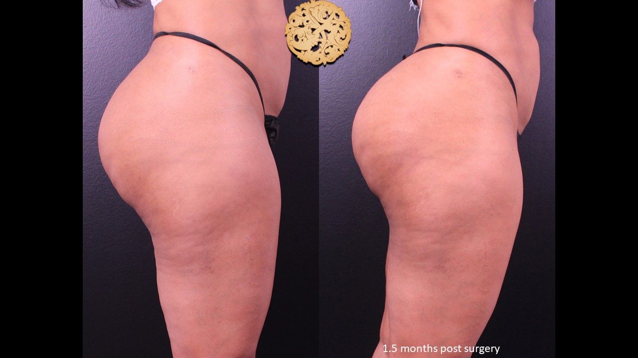 Cellfina Before & After