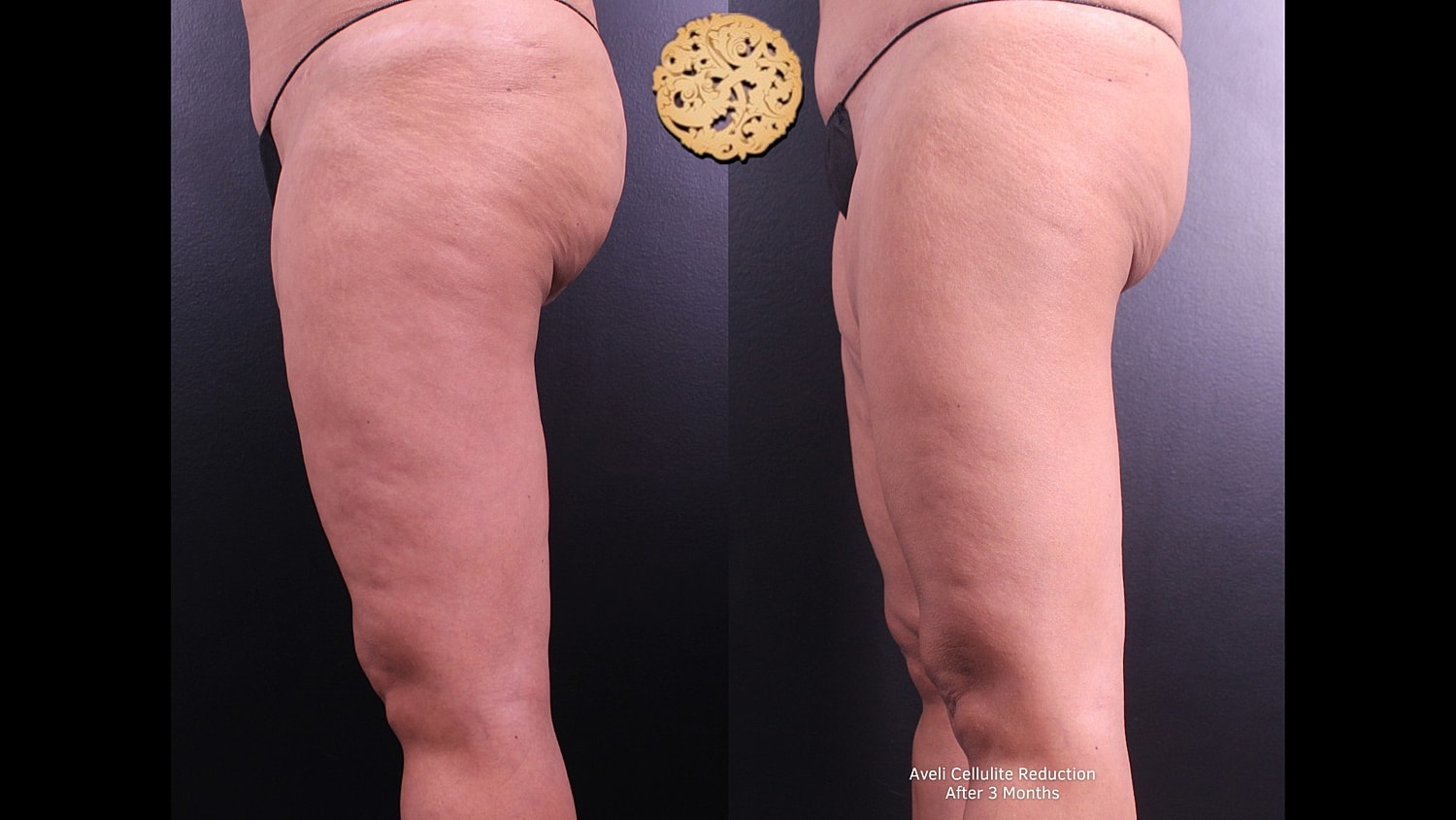 Cellulite reduction before and after treatment comparison.
