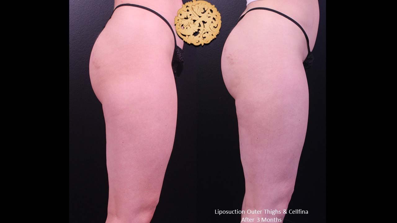 Cellfina Before & After