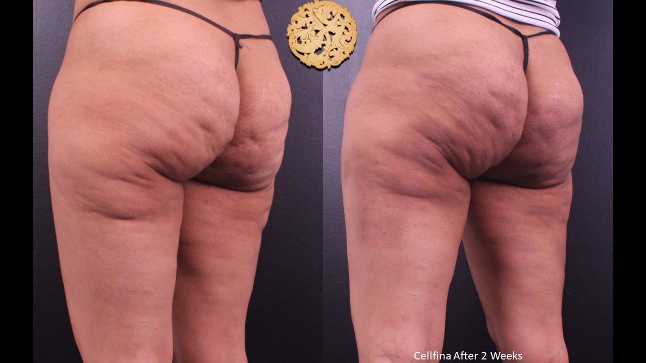 Cellfina Before & After