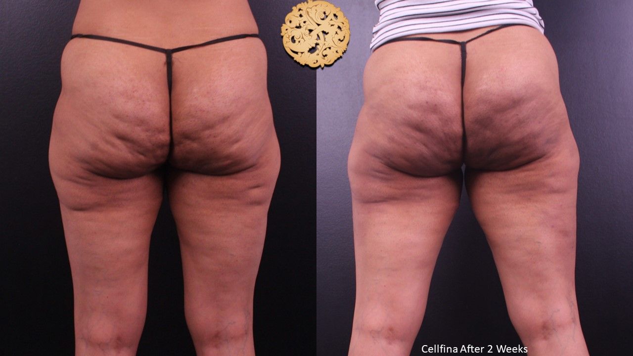Cellfina Before & After