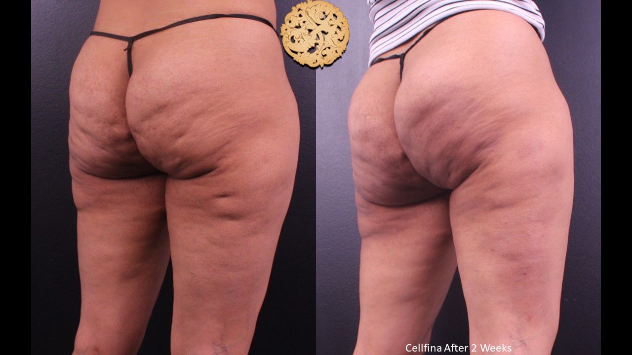 Cellfina Before & After