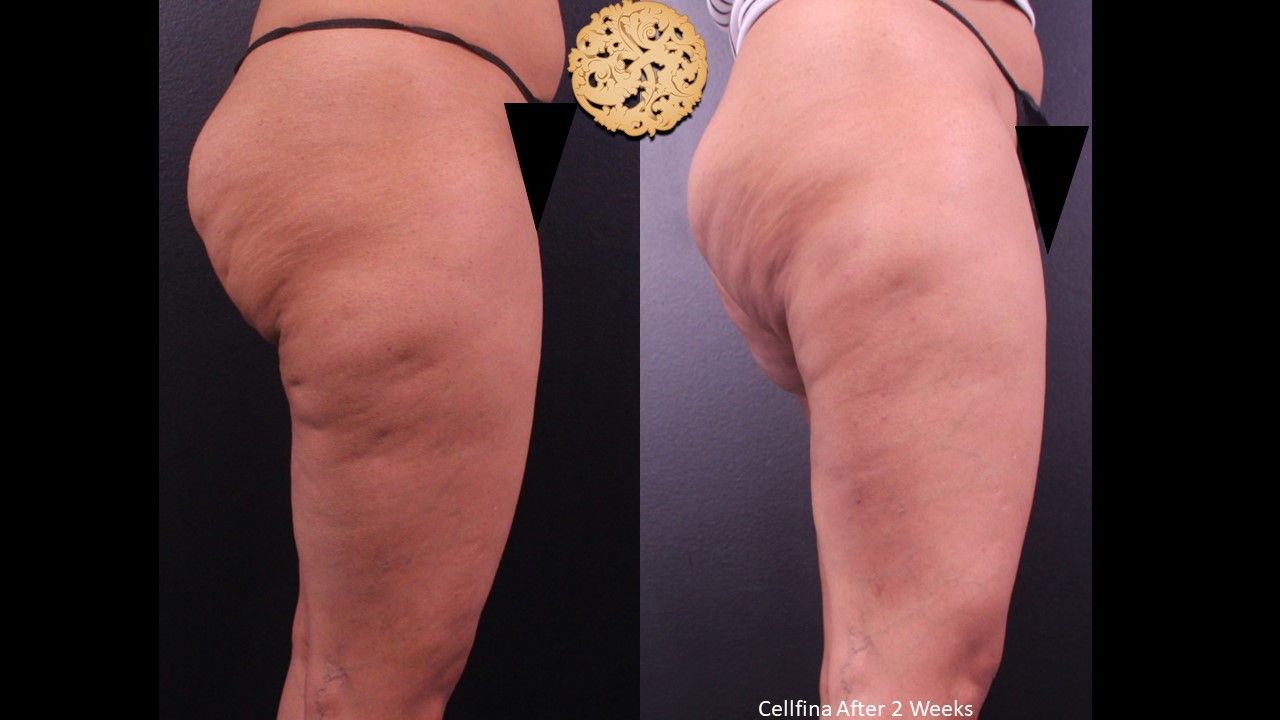 Cellfina Before & After