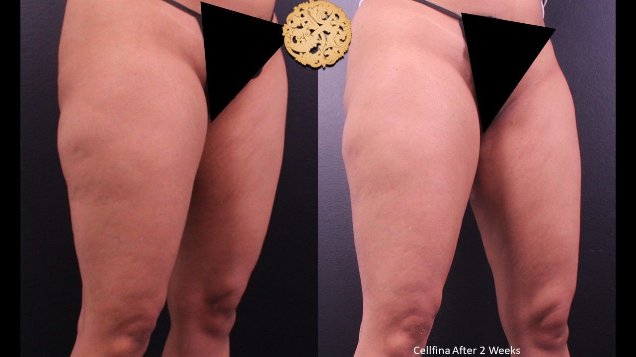 Cellfina Before & After