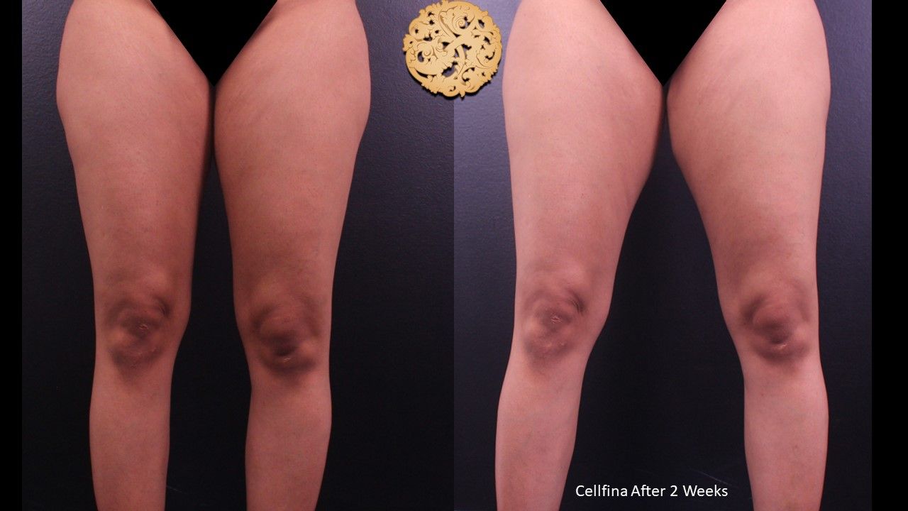 Cellfina Before & After