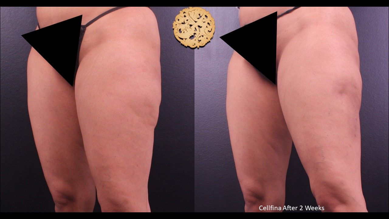 Cellfina Before & After
