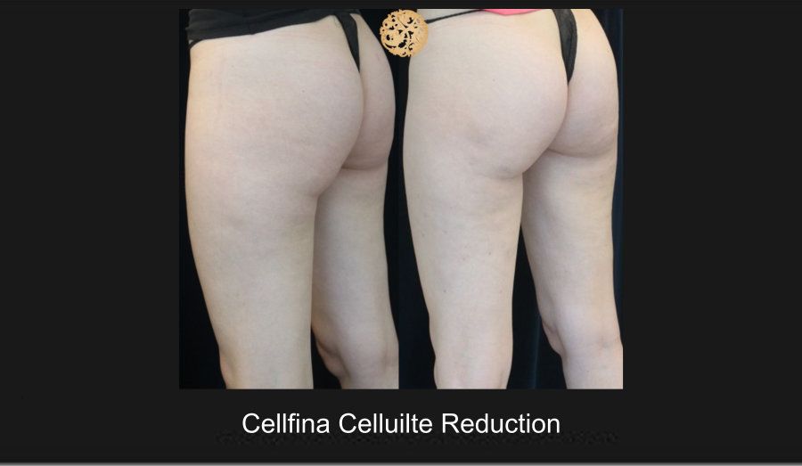 Cellfina Before & After