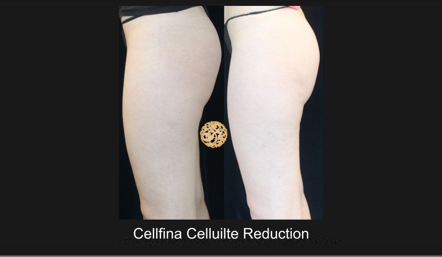 Cellfina Before & After