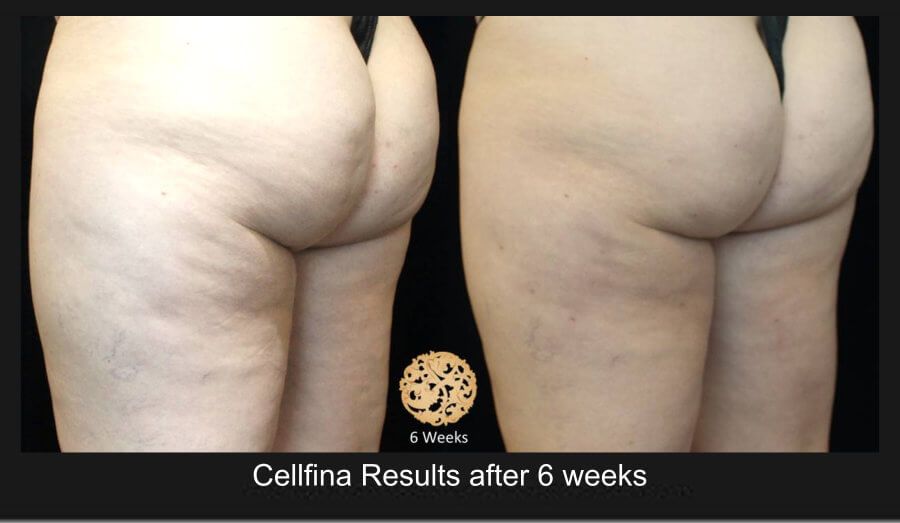 Cellfina Before & After