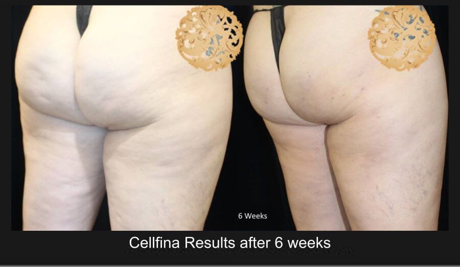 Cellfina Before & After