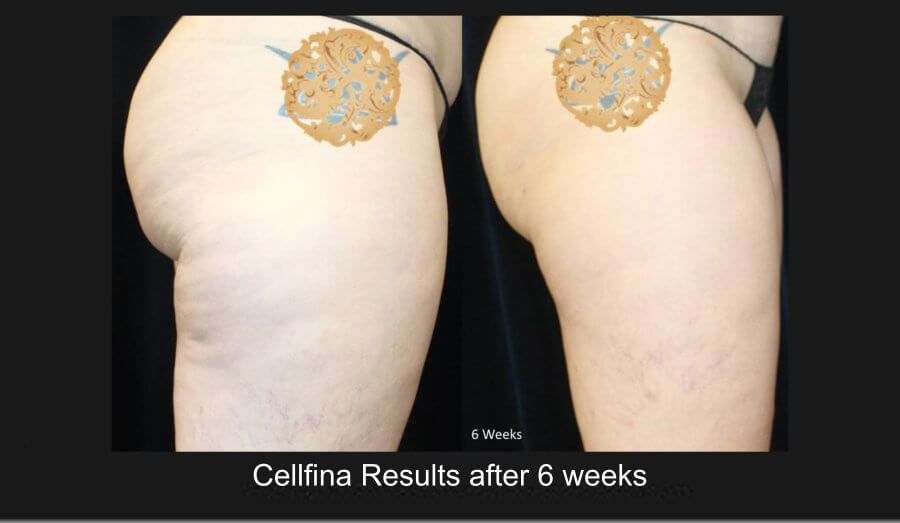 Cellfina Before & After
