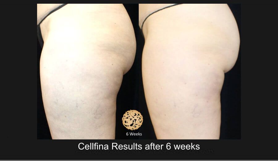 Cellfina Before & After