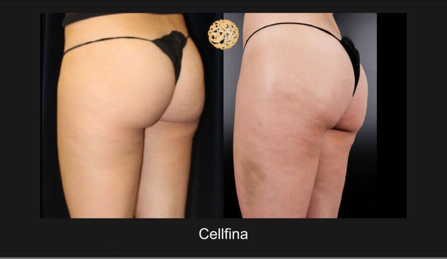 Cellfina Before & After