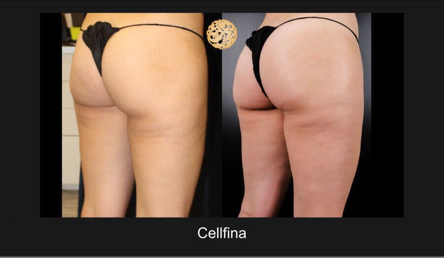 Cellfina Before & After