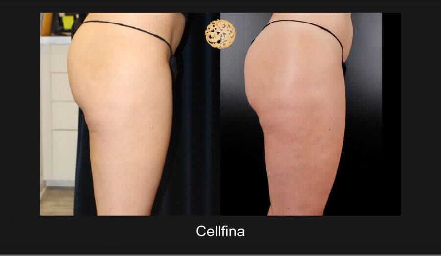 Cellfina Before & After