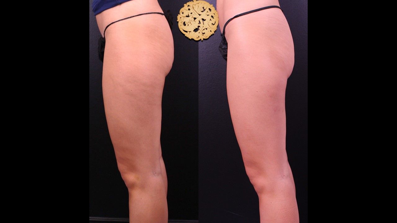 Cellfina Before & After