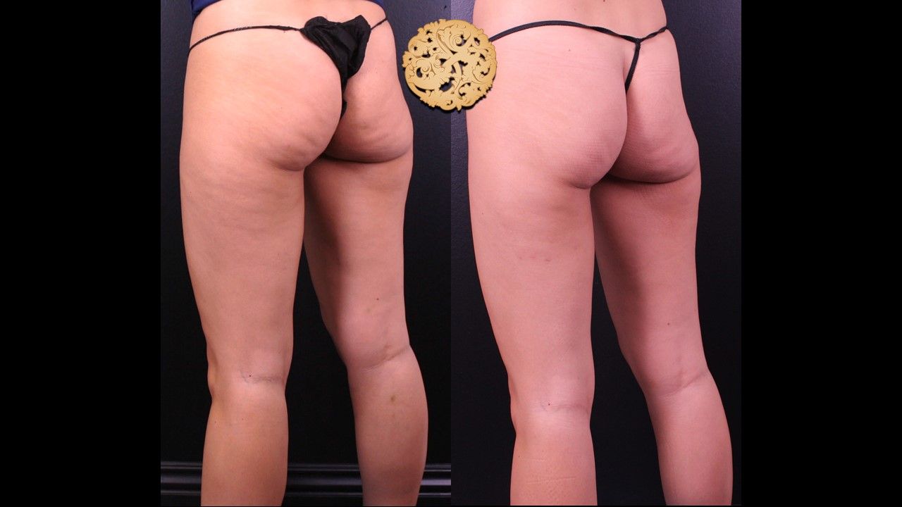 Cellfina Before & After