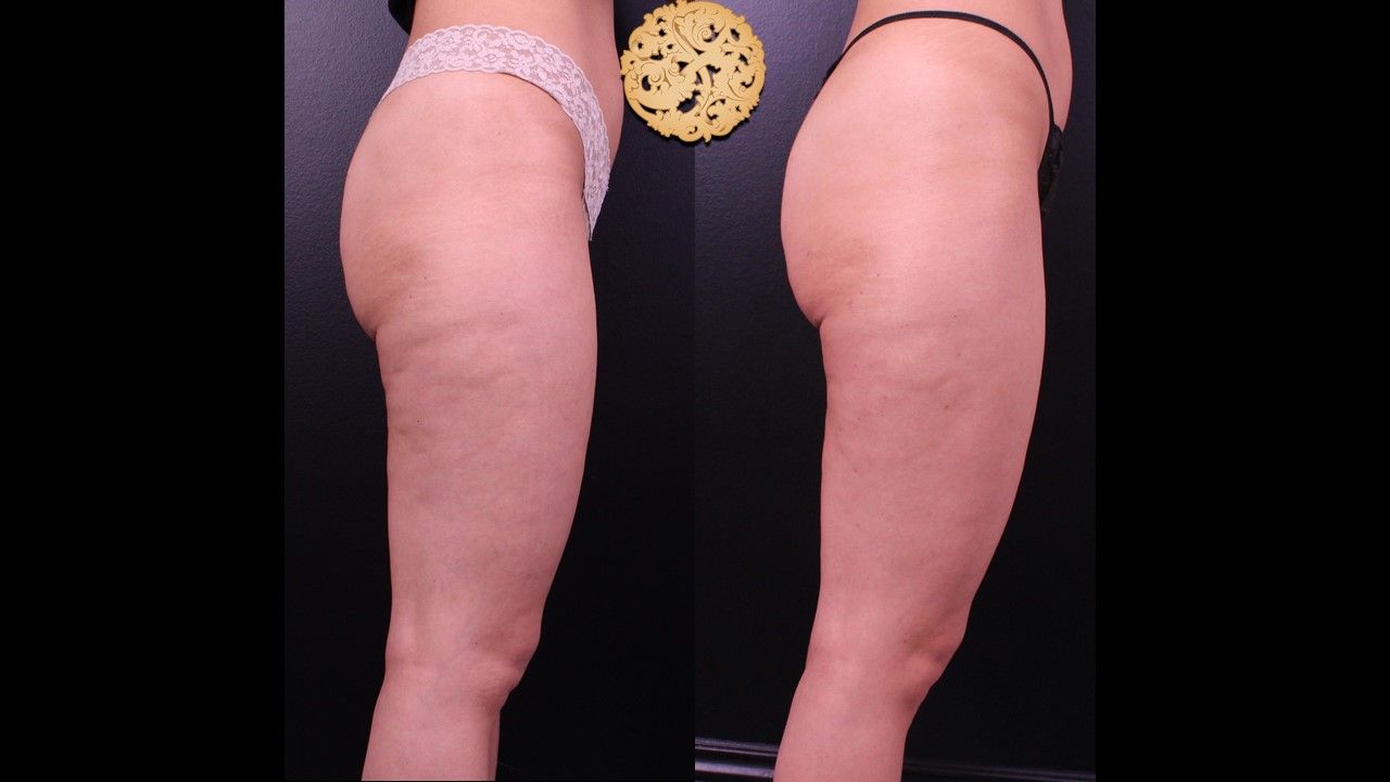 Cellfina Before & After