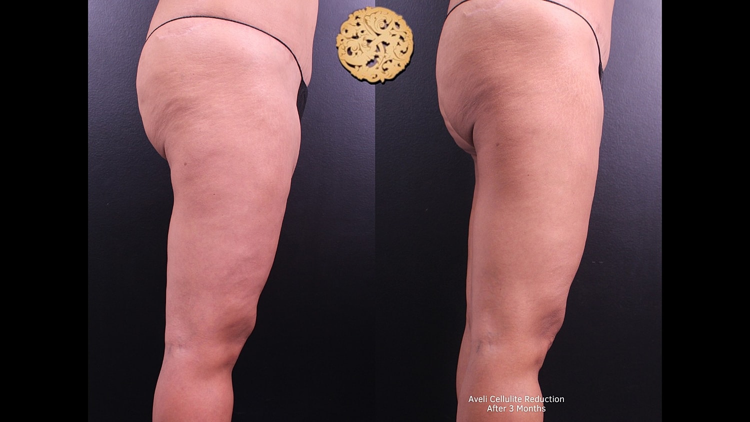 Cellulite reduction results comparison after three months.