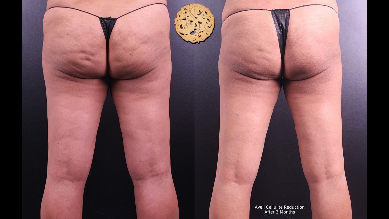 Cellulite reduction comparison after three months.