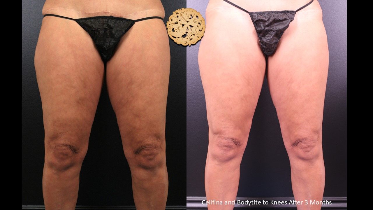Cellfina Before & After