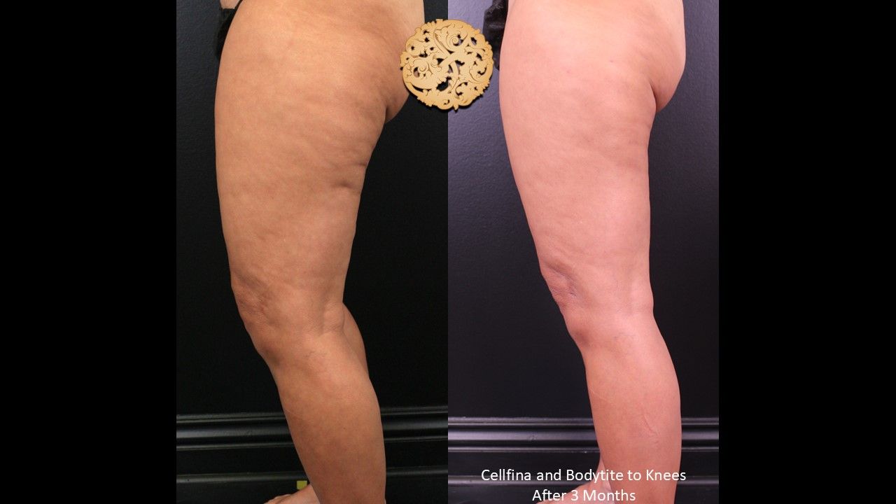 Cellfina Before & After