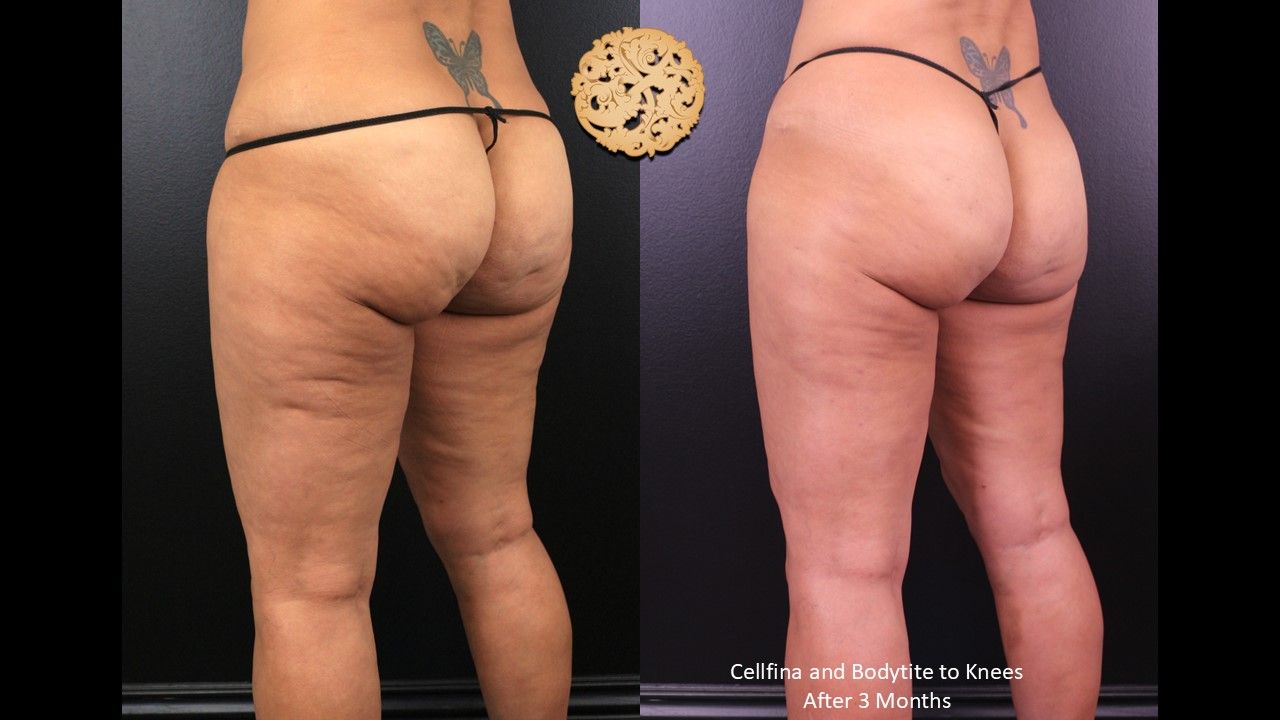 Cellfina Before & After
