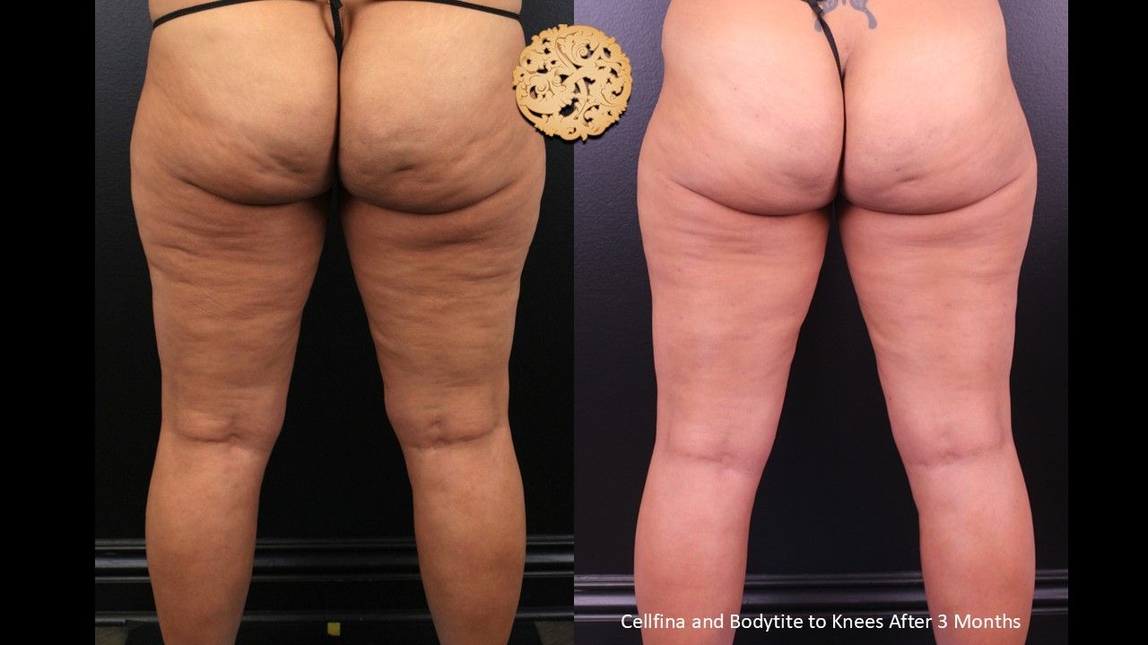 Cellfina Before & After