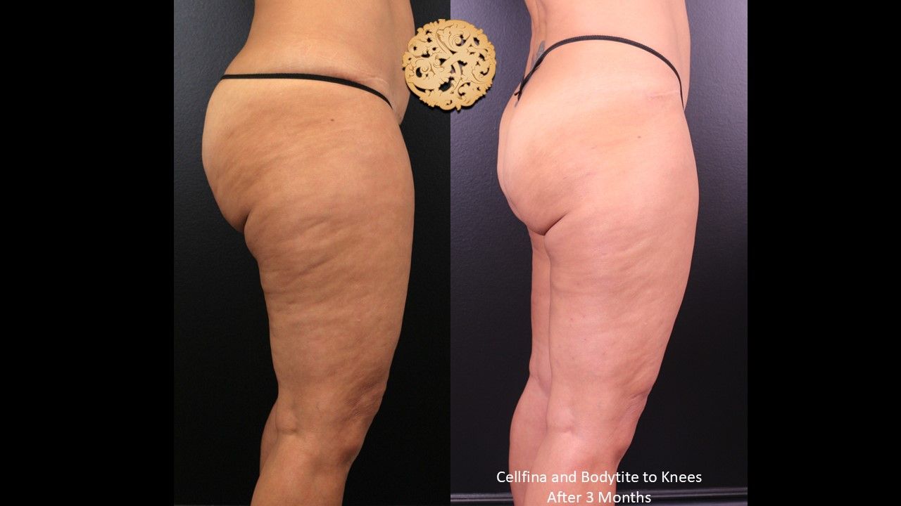 Cellfina Before & After
