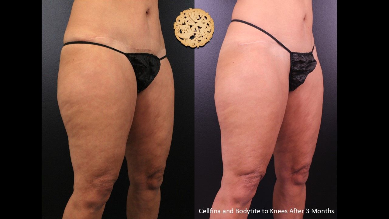 Cellfina Before & After