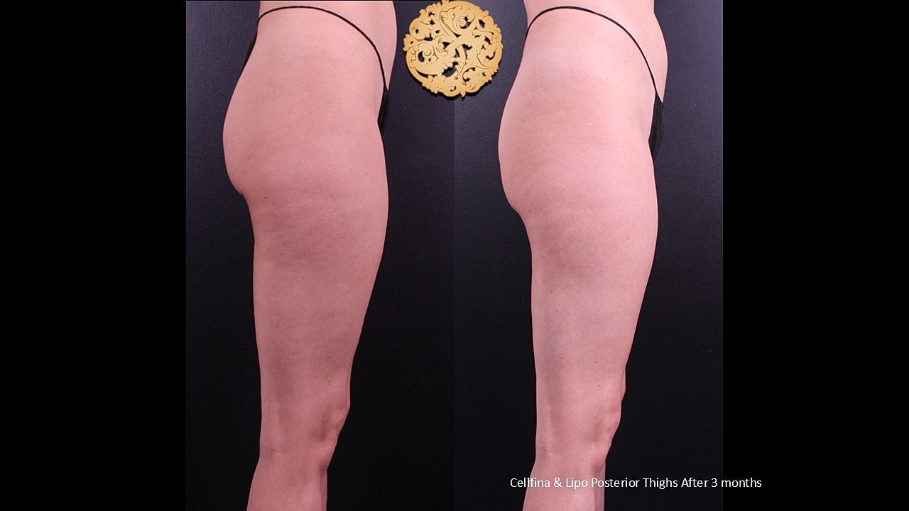 Cellfina & Lipo Posterior tights after 3 months
