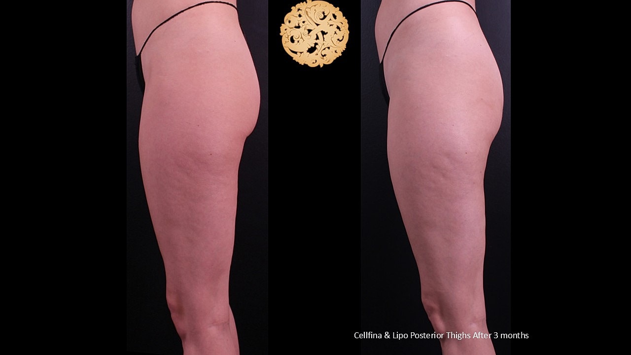 Cellfina & Lipo Posterior tights after 3 months