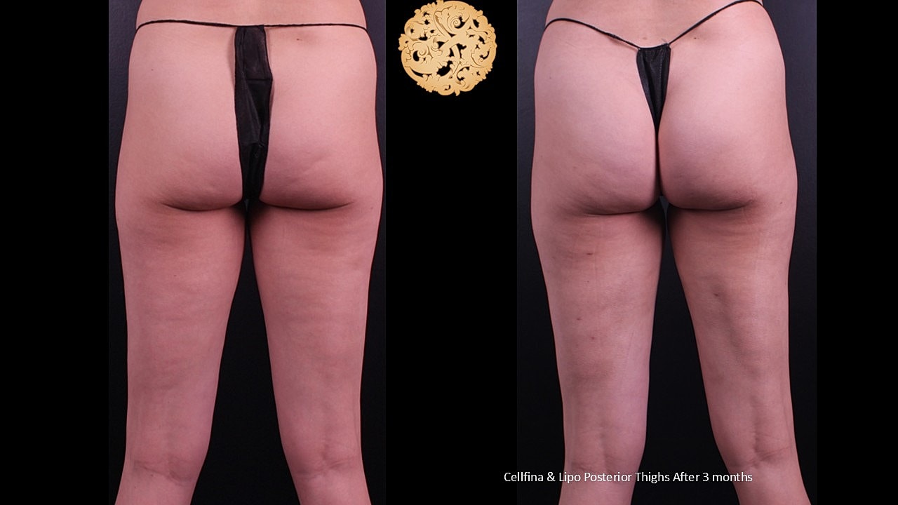 Cellfina & Lipo Posterior tights after 3 months