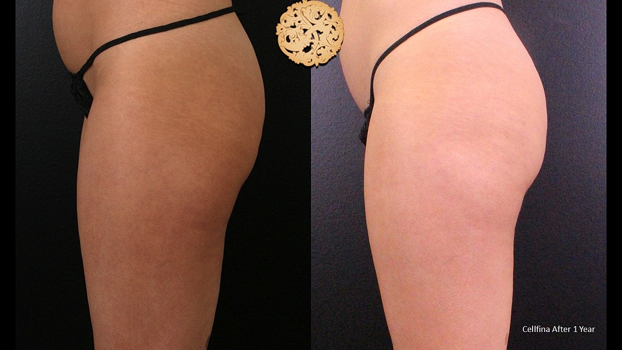 Cellulite Treatment Before & After