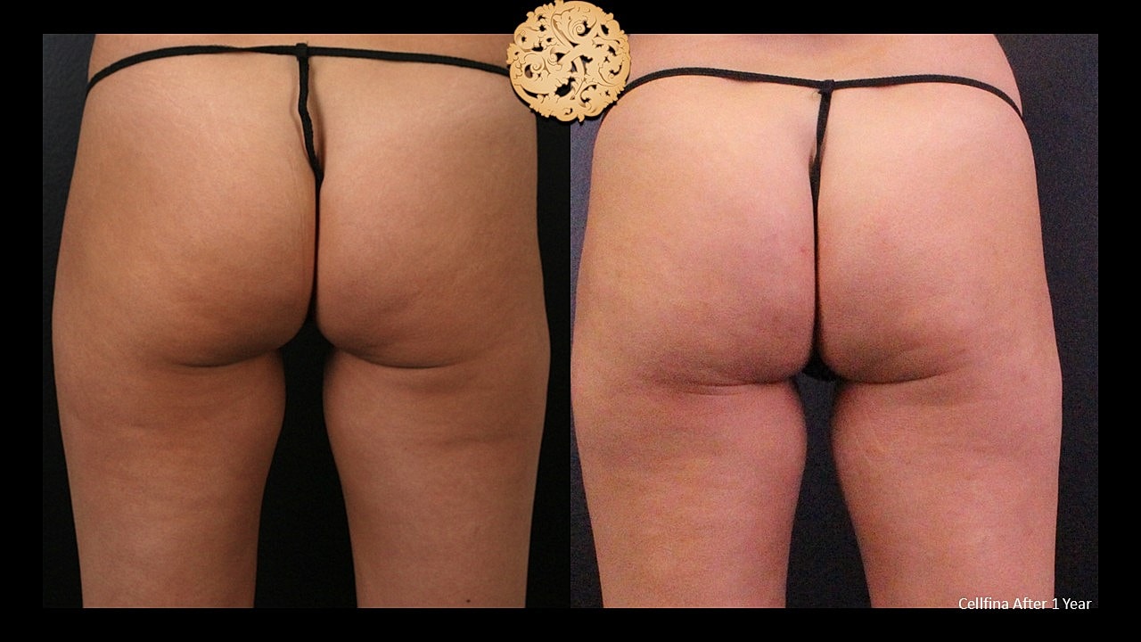 Cellulite Treatment Before & After
