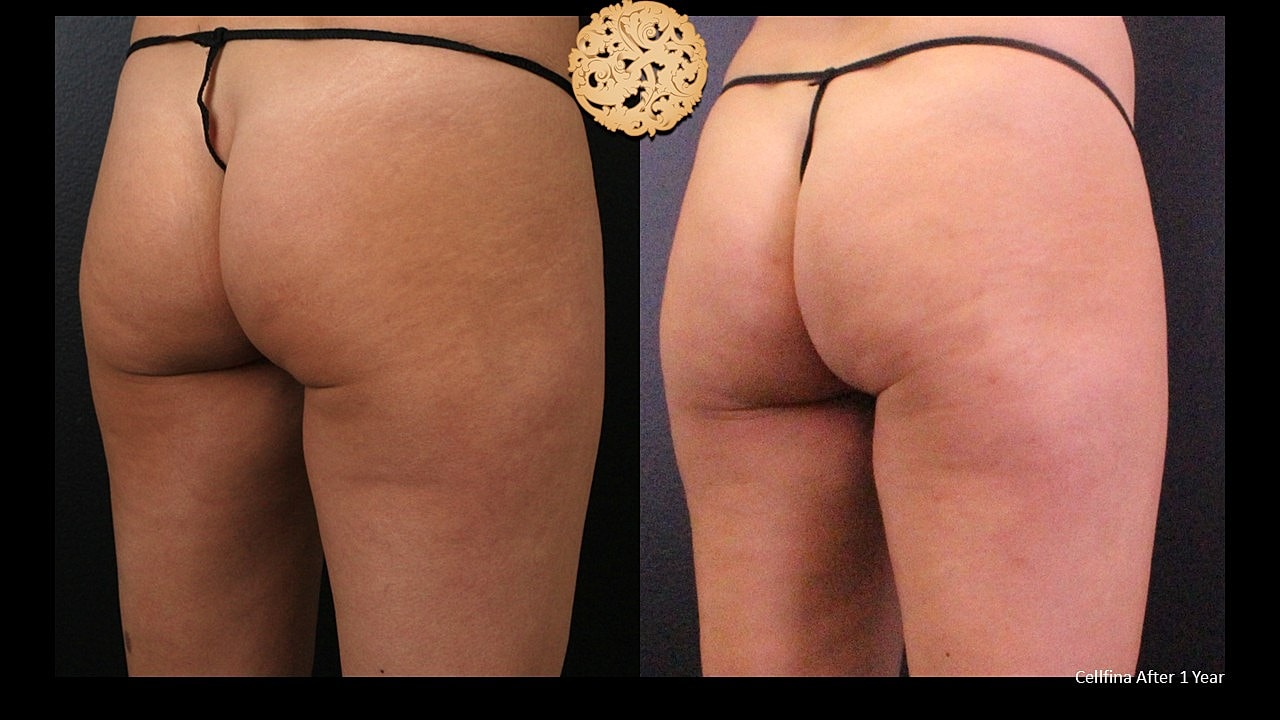 Cellulite Treatment Before & After
