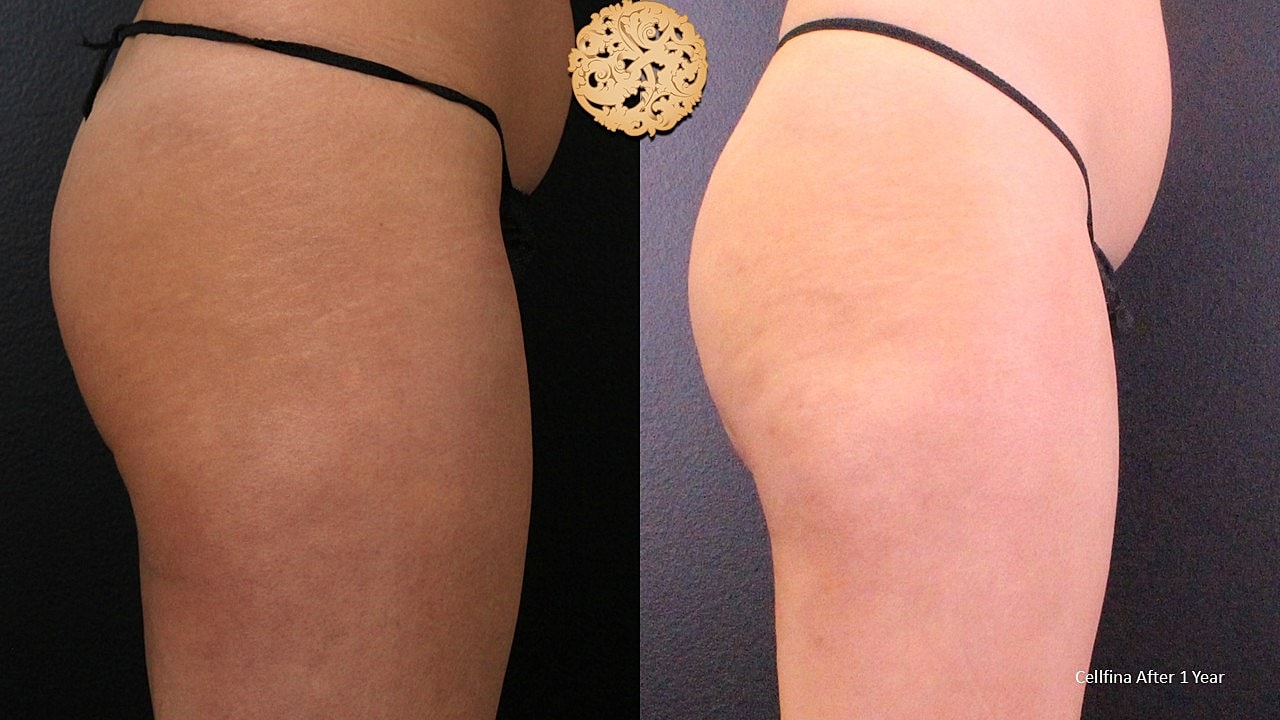 Cellulite Treatment Before & After