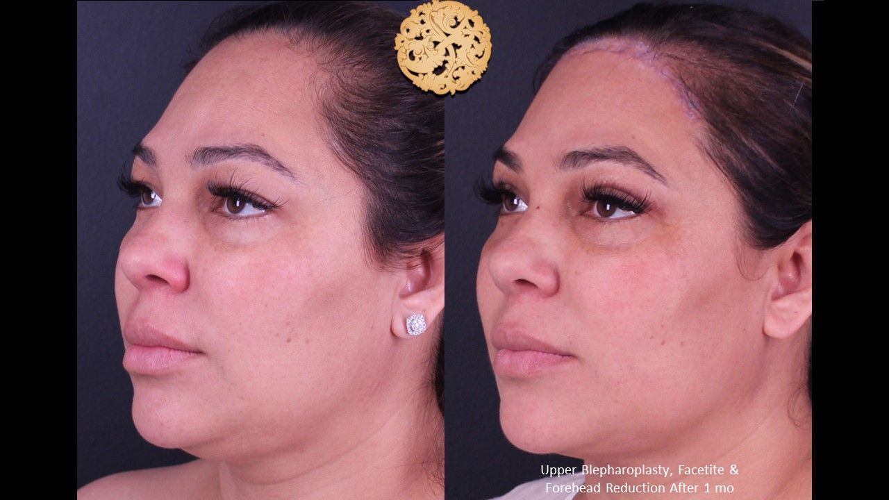 Forehead Reduction Before & After