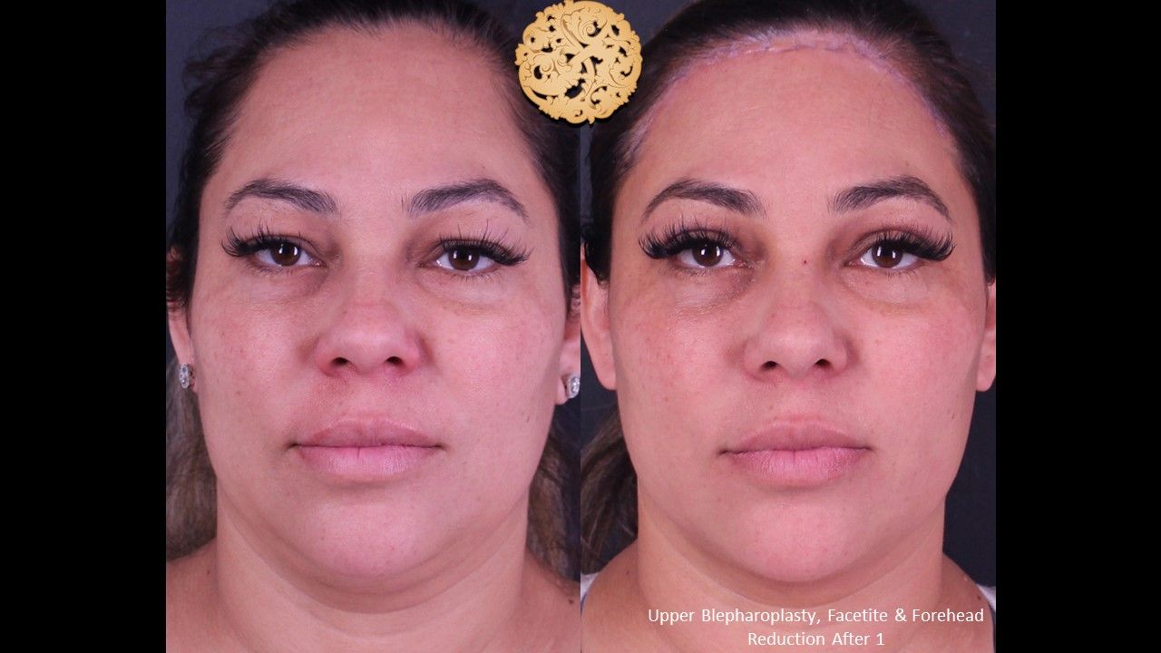 Forehead Reduction Before & After
