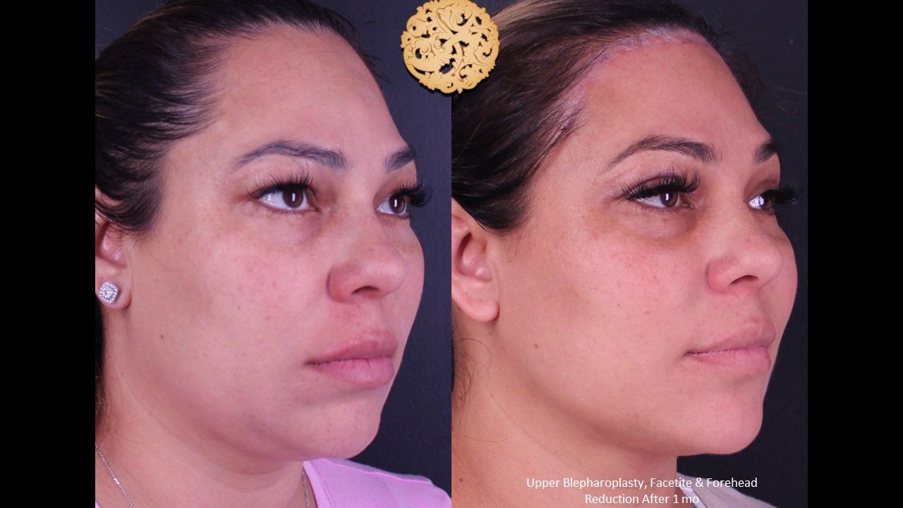 Forehead Reduction Before & After