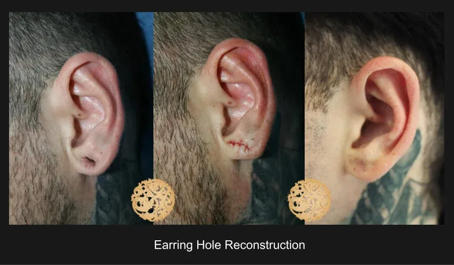 Earring Hole Reconstruction Before & After