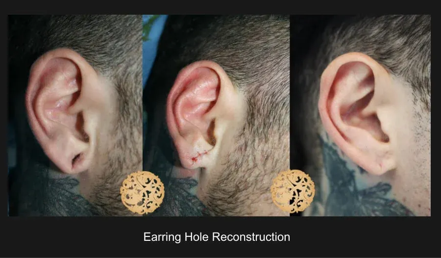 Earring Hole Reconstruction Before & After
