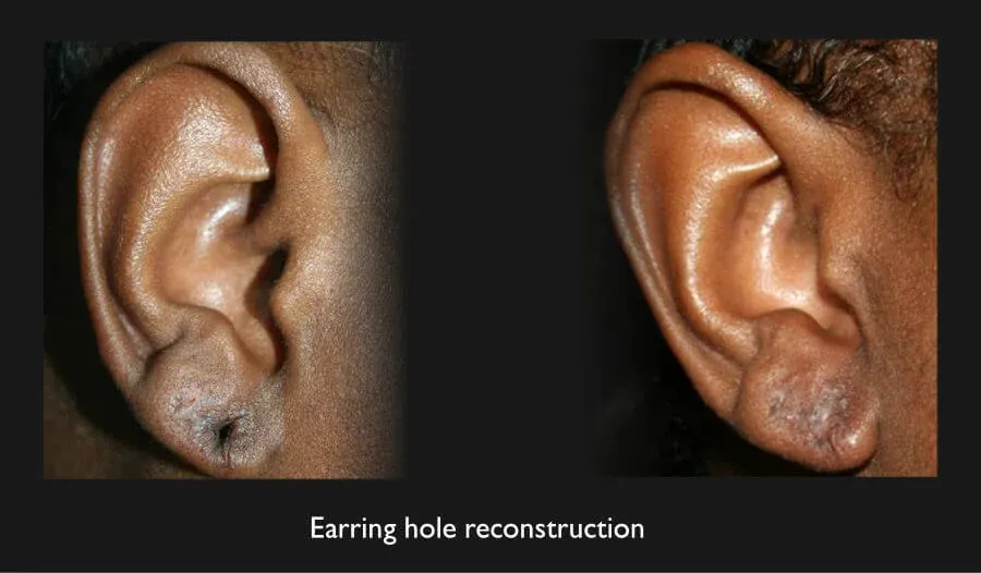 Earring Hole Reconstruction Before & After